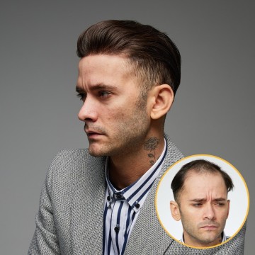 Prótese Capilar Homem: Cabelo 100% Humano